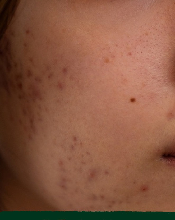 Pigmentation