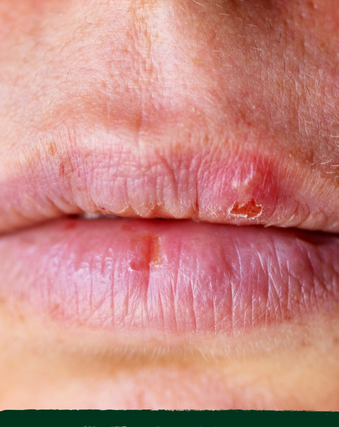 Pigmented Lip