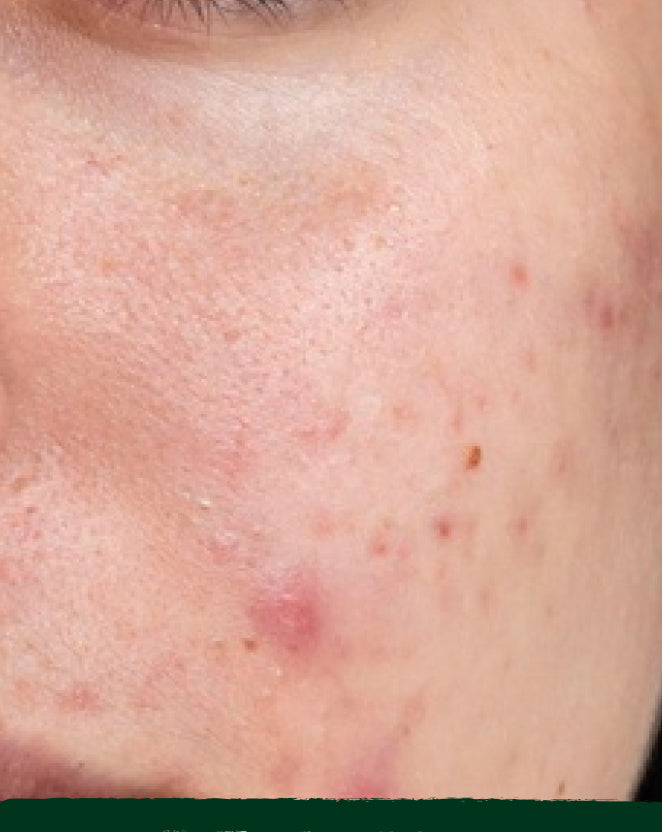 Acne