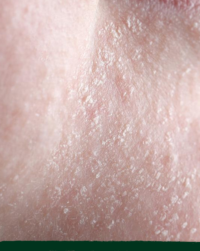 Dehydrated Skin