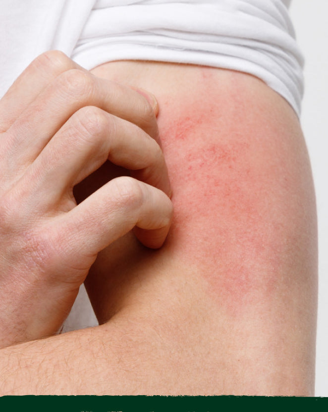 Itchy Skin